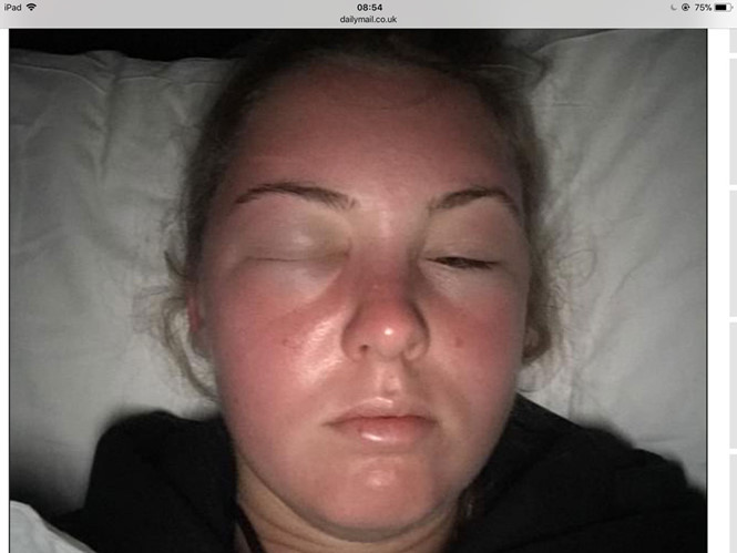 Cô gái người Anh bị ‘ngộ độc nắng’ khi tắm nắng ở bãi biển