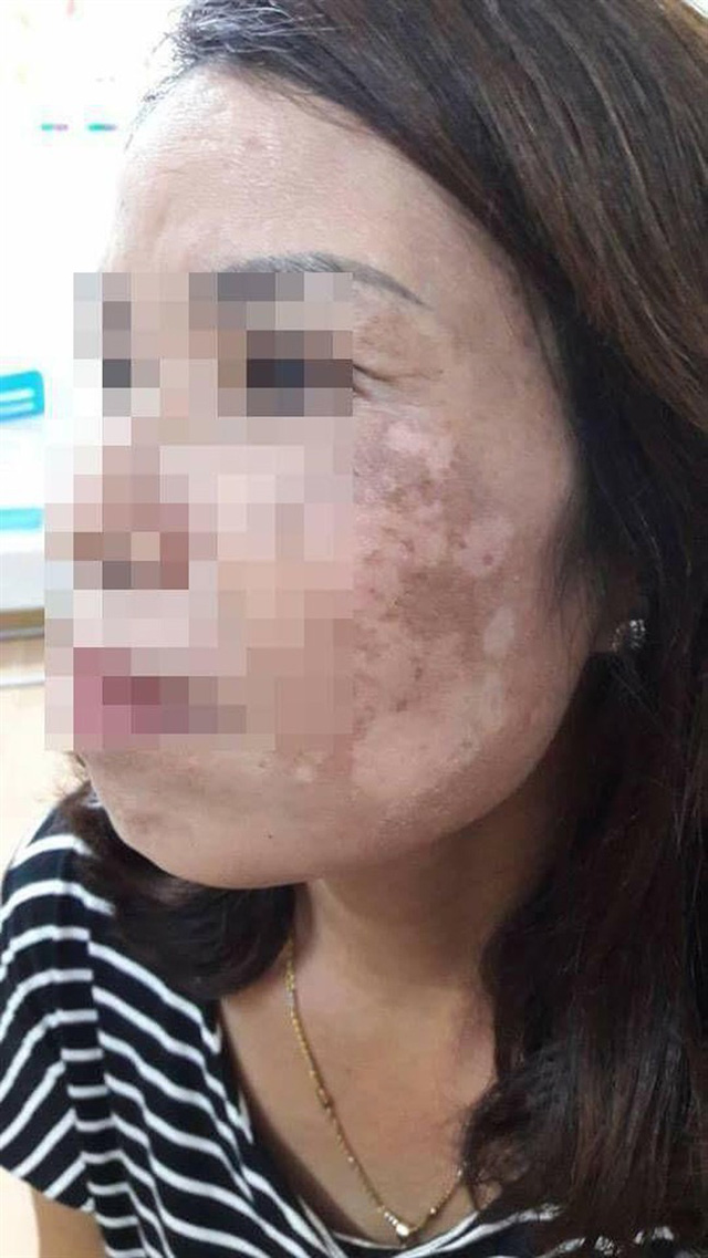 Dùng cao trầu không trị nám – một phụ nữ bị tổn thương da mặt nghiêm trọng