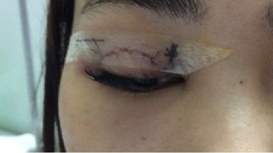 Hà Nội: Đi phẫu thuật nhấn mí làm đẹp một cô gái bị kim chui vào mắt