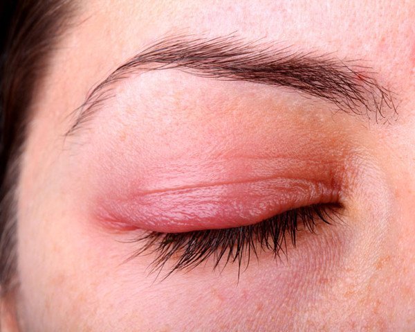 Một số căn bệnh về mắt cần phòng tránh vào mùa hè