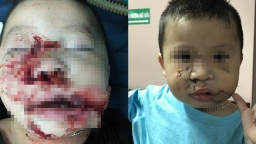 Hà Nội: Bé trai 2 tuổi bị chó đẻ cắn nát mặt, tổn thương cấu trúc mặt nghiêm trọng