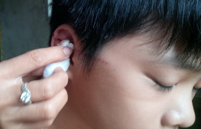 Em Lê Quang Đoàn, học sinh lớp 7A bị cánh quạt cắt một vết dài từ tai ra trước thái dương (Ảnh: Tuổi trẻ)Em Lê Quang Đoàn, học sinh lớp 7A bị cánh quạt cắt một vết dài từ tai ra trước thái dương (Ảnh: Tuổi trẻ)