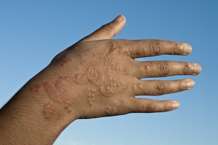  Mực xăm henna để lại sẹo lồi rất nguy hiểm. 