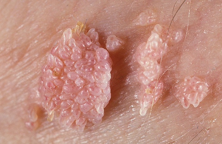 Nguy cơ ung thư cổ tử cung có thể do một số virus HPV gây ra