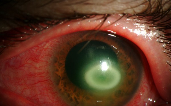 Khám phá thế giới về ký sinh trùng ăn mắt này đe dọa an toàn của những người chuộng kính áp tròng