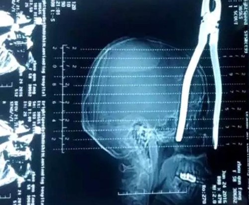 Hình ảnh chụp Xquang cho thấy chiếc kìm đâm sâu vào hộp sọ của nạn nhân. Ảnh: Shanghaiist