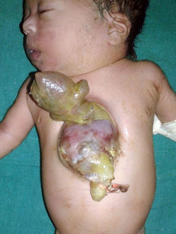 hình ảnh gây sốc em bé Ấn Độ sinh ra với trái tim bên ngoài