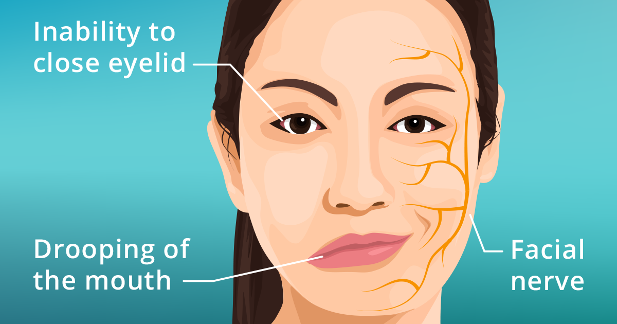 Bệnh liệt nửa cơ mặt có một số triệu chứng liên quan đến mắt, tai, vị giác...