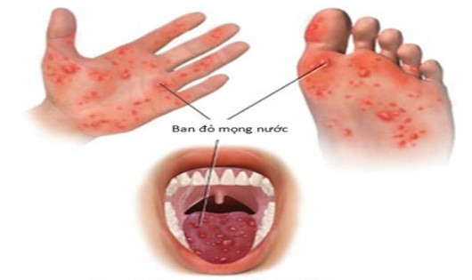 Bệnh chân tay miệng lây lan chóng mặt: Các dấu hiệu nhận biết sớm nhất