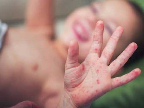 Bệnh chân tay miệng lây lan chóng mặt: Các dấu hiệu nhận biết sớm nhất