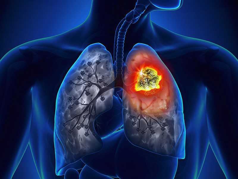 Ung thư phổi: 2 dấu hiệu nhận biết sớm nhất nhưng nhiều người hay bỏ qua
