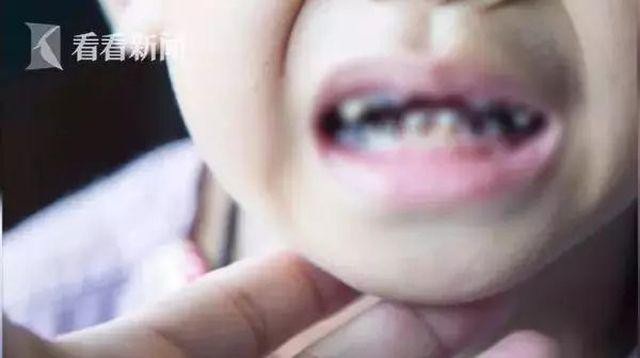 Bé 3 tuổi bị mủn nát 16 chiếc răng vì thói quen nhiều cha mẹ Việt mắc phải