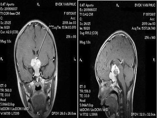 Bé 9 tuổi mắc u não: Những dấu hiệu cảnh báo bệnh cha mẹ thường bỏ qua