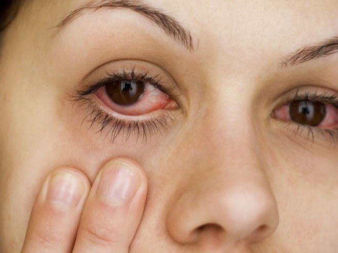 Bệnh đau mắt đỏ đang bùng phát mạnh, người dân nên đề phòng. Ảnh minh họa