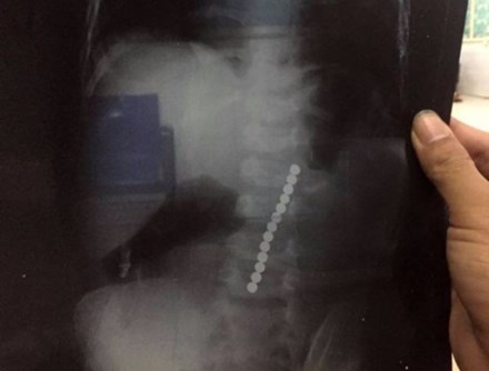 Hình ảnh những viên bi nằm trong bụng bé S. Ảnh: Tiền Phong 