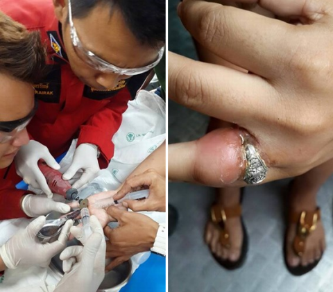http://baodatviet.vn/ Để lấy chiếc nhẫn ra khỏi tay cô gái các bác sĩ đã phải rất vất vả. doi-song/suc-khoe/nguoi-phu-nu-suyt-bi-hoai-tu-vi-deo-nhieu-nhan-chat-3338611/