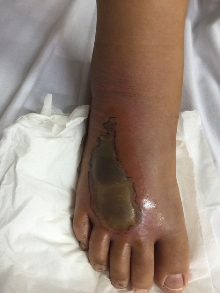 Vết cắn của rắn độc cắn khiến bàn chân bệnh nhân bị hoại tử. Ảnh: TTXVN 