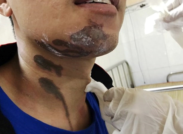 Nam thanh niên bị bỏng nặng vì chất tẩy rửa bồn cầu bắn lên trong lúc dọn nhà vệ sinh. Ảnh: Zing News 