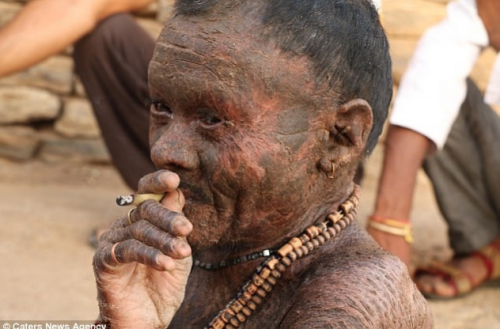  Người đàn ông mắc bệnh khô da nên cứ 10 ngày lột da một lần tại Ấn Độ. Ảnh: ĐSPL