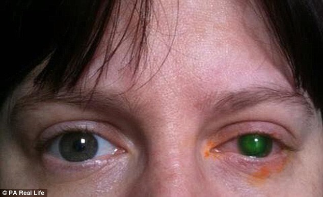  Do đeo kính áp tròng đi bơi nên bà Jenkins đã bị nhiễm khuẩn phải phẫu thuật giác mạc mắt trái mới khôi phục lại được. Ảnh: Dailymail