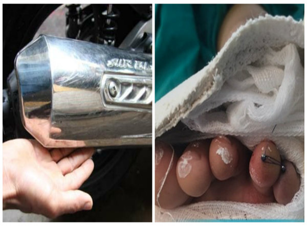  Ốp ống pô xe Air Blade khiến ngón áp út bàn chân trái của bé trai bị cắt đứt 