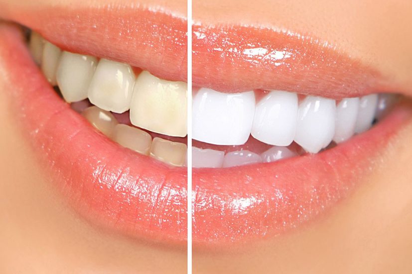 Làm trắng răng bằng các sản phẩm như bột, miếng dán cần thận trọng 