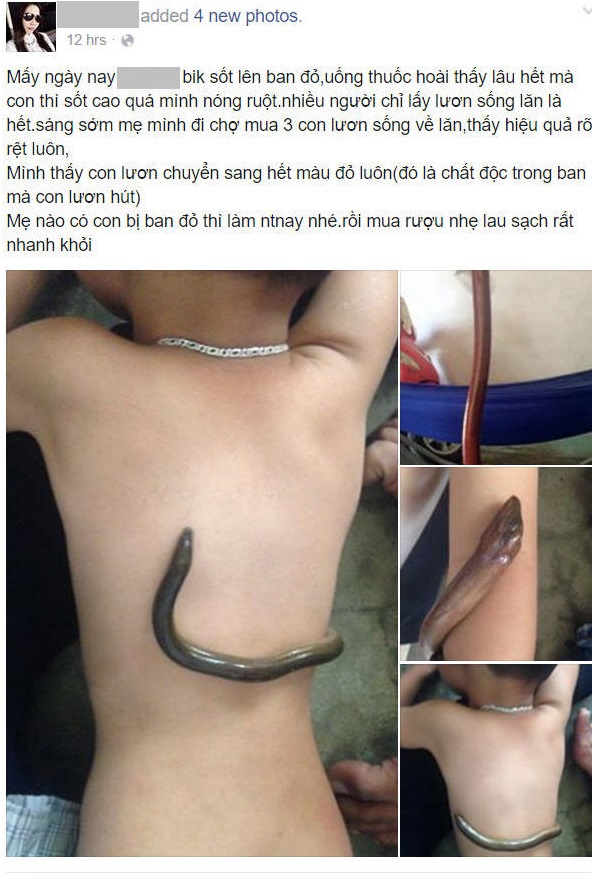 Sự thật về cách hạ sốt bằng lươn sống