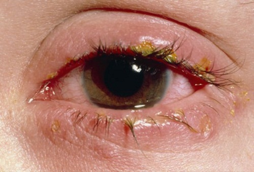 Gây bệnh cho mắt vì sử dụng sản phẩm trang điểm mắt rởm
