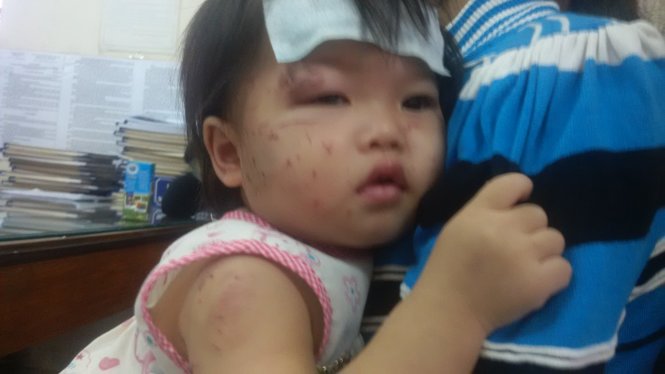 Bé 1 tuổi chi chít vết cào cấu khi đi nhà trẻ: Nhập viện vì viêm phế quản