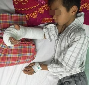 Bệnh viện Nhi Trung ương nối bàn tay bị chém gần đứt lìa cho bé trai 8 tuổi