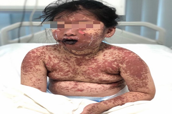 Bé gái 7 tuổi có làn da như 'bỏng nặng' vì dị ứng thuốc