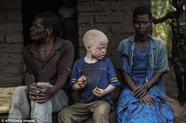 Cậu bé bị bệnh bạch tạng ngồi bên ba mẹ mình ở Malawi. Ảnh: AFP