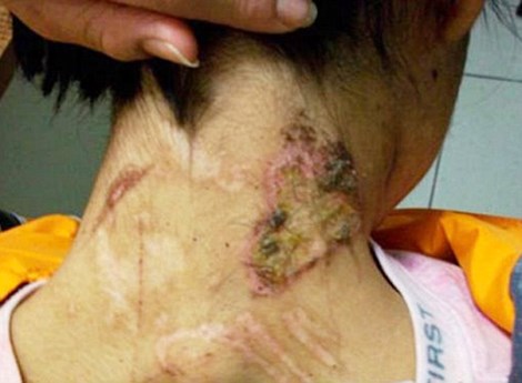 Vết bỏng nặng trên cổ của cô gái bị bắt làm nữ nô lệ suốt 2 năm qua ở Mexico