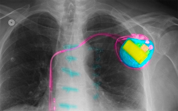 Máy trợ tim là một thiết bị nhỏ được đặt trong lồng ngực, giúp kiểm soát nhịp tim bất thường
