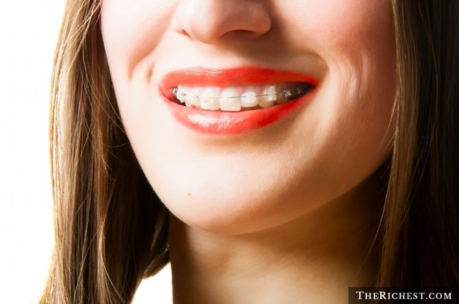 Niềng răng trong suốt có tính thẩm mỹ cao hơn, người đeo sẽ đỡ bị chê xấu hơn khi 