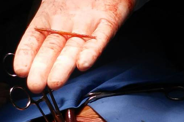 Chuyện lạ có thật: Đi phẫu thuật bỗng phát hiện một cây tăm nguyên vẹn trong tim
