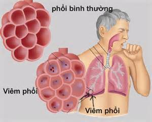 Viêm phổi là bệnh phổ biến ở người cao tuổi vào mùa đông