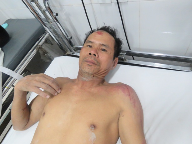 Nạn nhân Nguyễn Văn Cao đang điều trị tại bệnh viện sau vụ tai nạn sập giàn giáo