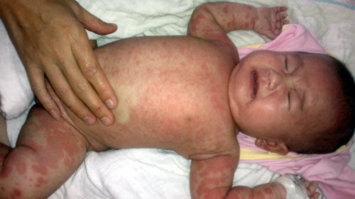 Bệnh sốt phát ban có thể thành dịch không kém mùa hè