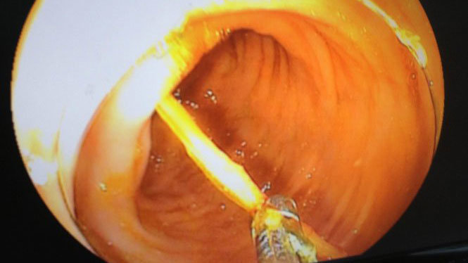 Hình ảnh nội soi thấy chiếc tăm tre đâm thủng thành đại tràng của bệnh nhân