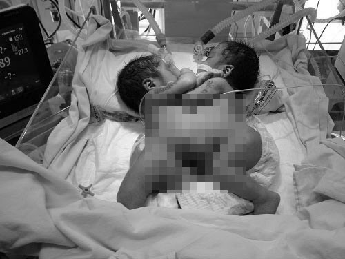 2 bé song sinh dính liền tổn thương tim phức tạp đã ra đi mãi mãi là một trong những tin tức nổi bật 24h qua    