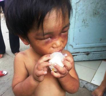 Cháu Nguyễn Thành ĐỨc 3 tuổi bị đánh bầm dập và bắt đi ăn xin