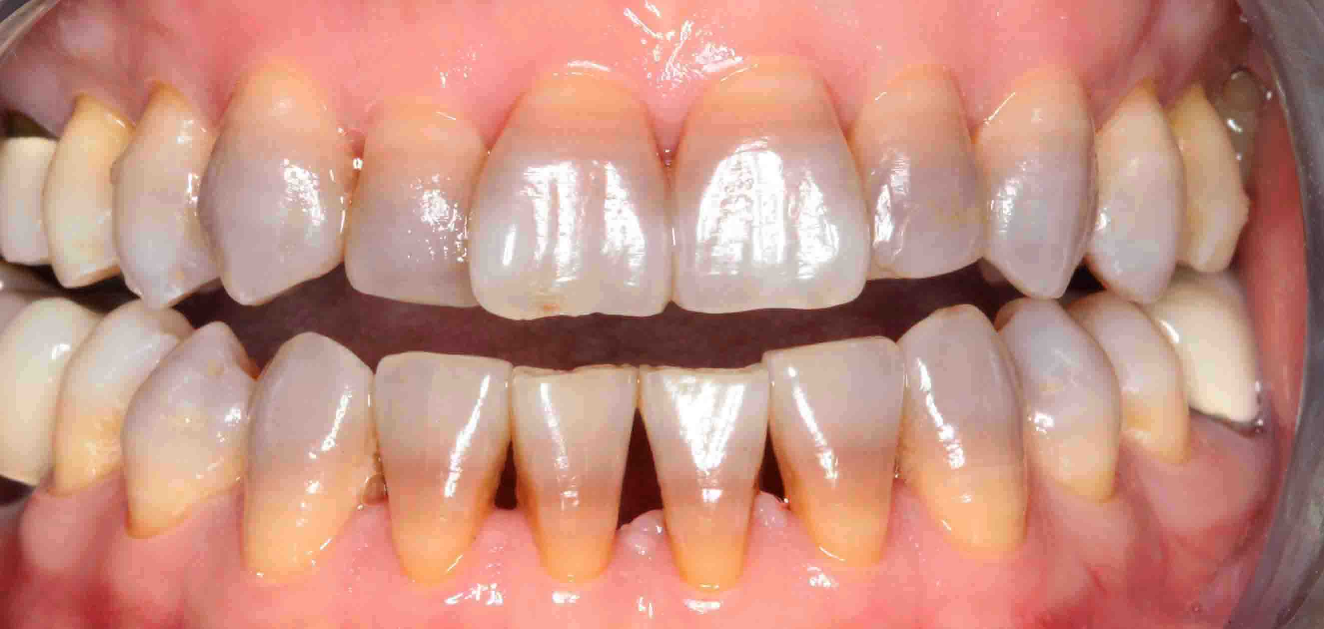 Tẩy trắng răng sai cách tại nhà có thể hủy hoại men răng