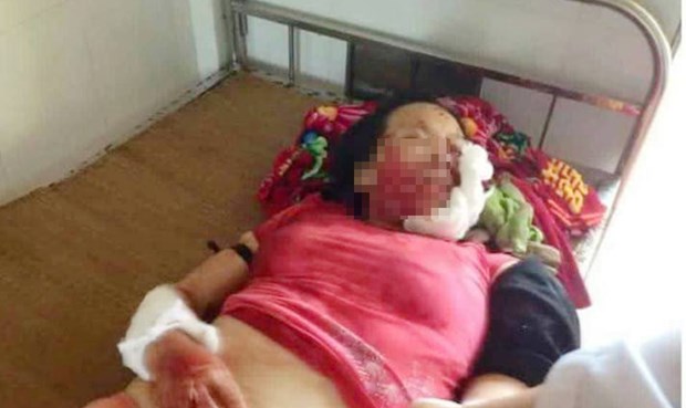 Người vợ bị chồng chém vỡ mặt khi nhập viện