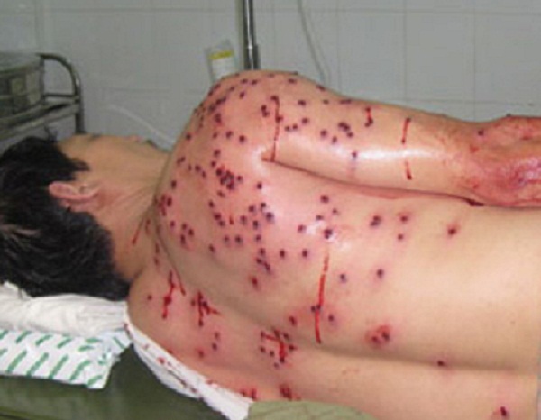 Kết quả chụp X-Quang ban đầu xác định nạn nhân có 14 viên đạn bi trong người
