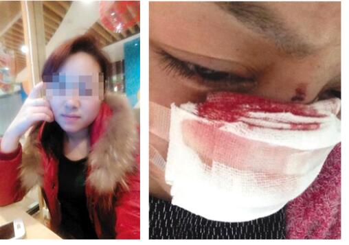 Cô Li tiết lộ mình bị chồng cắt mũi và bạo hành nhiều lần