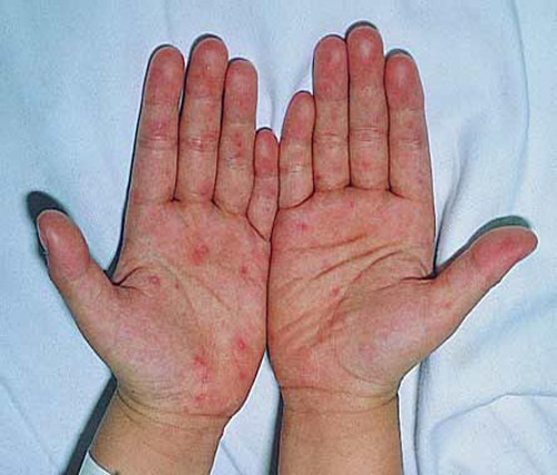 Dấu hiệu đặc trưng của bệnh tay chân miệng là phát ban dạng phỏng nước ở lòng bàn tay, lòng bàn chân