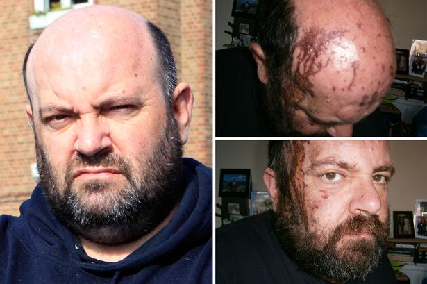 Derrick Mahoney bị thương nghiêm trọng sau vụ tạt axit như tin tức mới nhất đưa