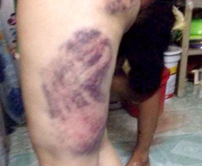 Vết bầm tím trên chân chị Thu sau khi bị công an đánh, theo những tin tức pháp luật mới nhất hôm nay