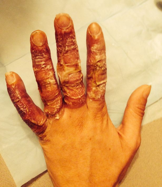 Bàn tay của cô gái sau khi được điều trị tại bệnh viện. Ảnh Mirror